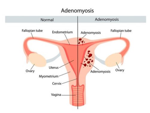 Upaya Mendeteksi dan Mengatasi Adenomiosis
